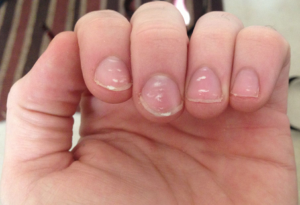 white-spots-nails