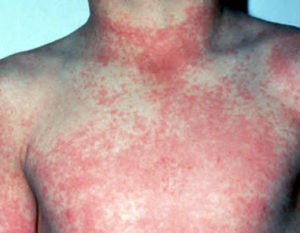 dengue_rash