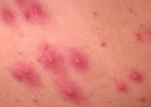 ebola-rash