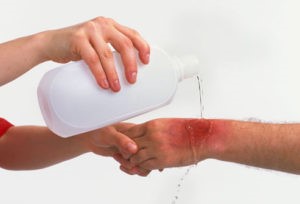 getty_rm_photo_of_cold_water_on_burnt_hand