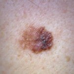 melanoma